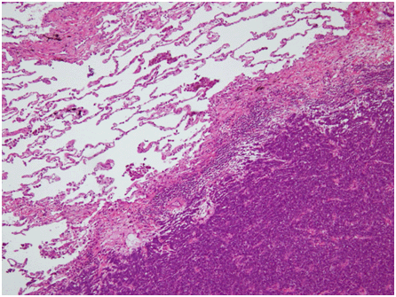 Small cell carcinoma 